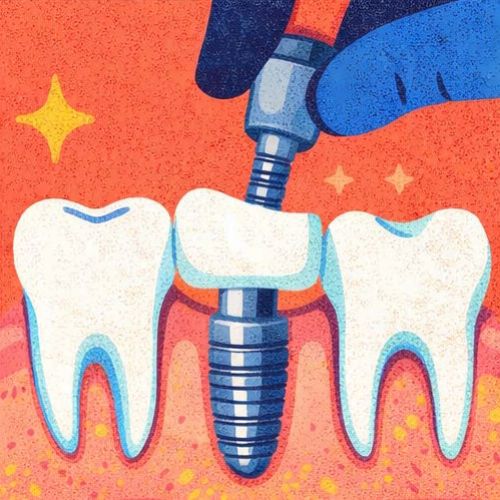 Зубная имплантация
