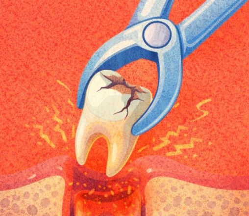 Удаление зубов