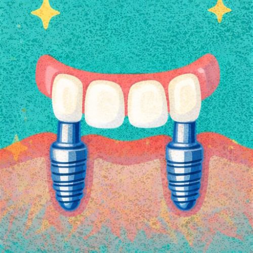 Протезирование передних зубов