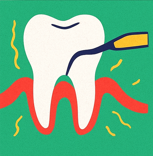 Лечение периодонтита